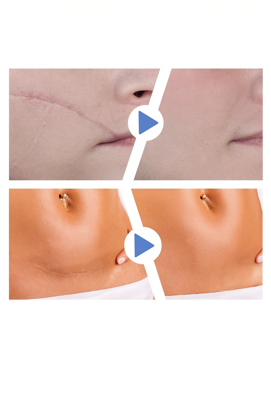 Citas de Silicona para Cicatrices